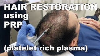 Scalp Hair Restoration using Platelet Rich Plasma  West End Plastic Surgery [upl. by Amalea]