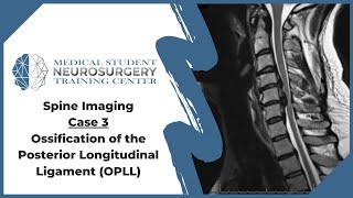 Spine Imaging Case 3 Ossification of the Posterior Longitudinal Ligament OPLL [upl. by Enitsyrhc]