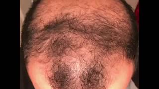 6 months using minoxidil  Rogaine 5 Before amp After results [upl. by Rooke56]