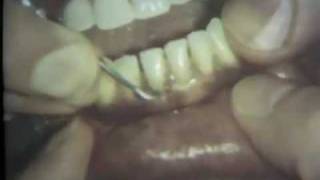 Scaling and Root Planing Part II Mandibular Teeth [upl. by Oirevlis]