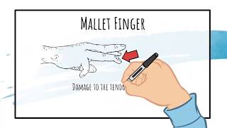 How to Splint Different Finger Injuries [upl. by Narag]