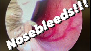 Nosebleeds epistaxis causes prevention treatments and more [upl. by Boehike]