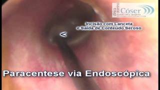 Paracentese Timpânica via EndoscópicaTympanic Paracentesis Otoendoscopic technique [upl. by Bilbe20]