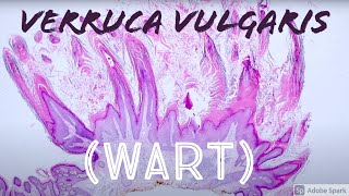 Wart Under the Microscope Verruca Vulgaris vs Seborrheic Keratosis Pathology [upl. by Aniala]