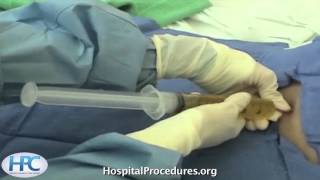 Paracentesis Procedure Video Trailer [upl. by Atlante]