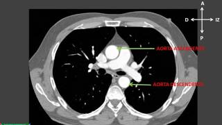 Int Anatomía por Imágenes del Tórax en Tomografía [upl. by Mikaela]