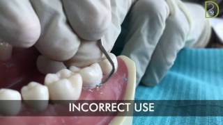 Dentiscope  How to use supragingival scalers [upl. by Dierdre]