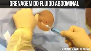 Drenagem do fluido abdominal PARACENTESE [upl. by Novyak]