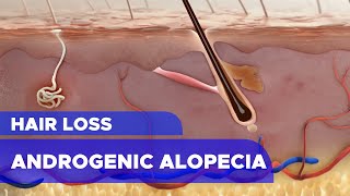 Hair Loss Androgenic Alopecia [upl. by Sidney156]