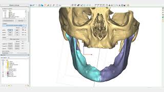 Mandible Reconstruction Tutorial  PROPLAN CMF™ [upl. by Yesor]