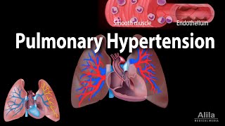 Pulmonary Hypertension Animation [upl. by Latreese144]