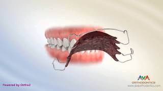 Orthodontic Retainer  Hawley [upl. by Analaf410]