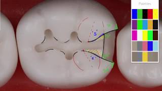 Class II Amalgam 19 MO Acadental  Amalgam Preparation Technique [upl. by Sitruc115]