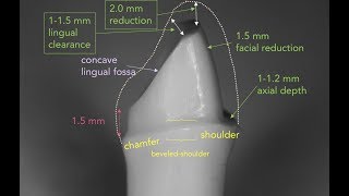 Anterior PFM Preparation  Dr Richard Stevenson [upl. by Zirtaeb]