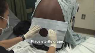 Adult Spinal Tap Procedure Video [upl. by Delbert]