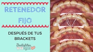 RETENEDORES DE ORTODONCIA FIJOS  Después de tus Brackets [upl. by Hardi]