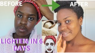 How I How i BRIGHTENED MY SKIN IN 6 DAYS REALISTIC and Natural way to reduce hyperpigmentation [upl. by Reyem]