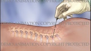 Lumbar IDET Intradiscal Electrothermal Therapy Procedure [upl. by Elirpa]