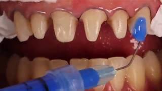 Adhesive cementation of ceramic veneers [upl. by Einahpats]