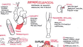 Atherosclerosis  Pathophysiology [upl. by Arait]