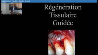 Regeneration Tissulaire Guidee  Dr Paul Mattout [upl. by Kyriako]