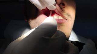 Maxillary Infiltration Anesthesia Technique [upl. by Song592]