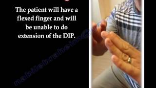 Boutonniere Deformity  Everything You Need To Know  Dr Nabil Ebraheim [upl. by Glenine]