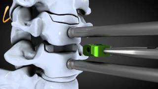 Hernie discale cervicale  Spinal disk herniation  Kisco International [upl. by Liddle]