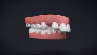 Invisalign® Treatment with Manidublar Advancement [upl. by Htinnek308]