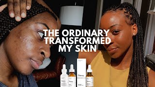 The Ordinary Skin Transformation Mandelic Acid Cleared My Acne  xoreni [upl. by Mccreary]