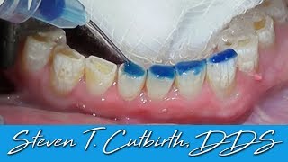 Bonding Worn Anterior Teeth  Dental Minute with Dr Steven T Cutbirth DDS [upl. by Gwenora]