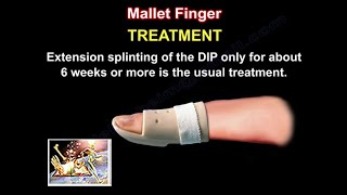 Finger Injuries  Mallet Finger  How to splint [upl. by Bogey]