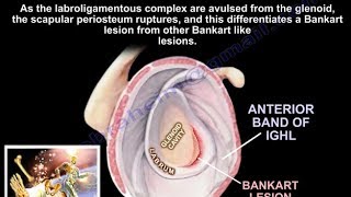 Lesions Of The Shoulder Bankart Lesion  Everything You Need To Know  Dr Nabil Ebraheim [upl. by Trin73]