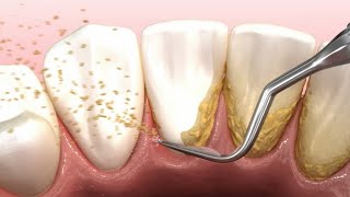 Dental scaling teeth animation [upl. by Ennoirb206]