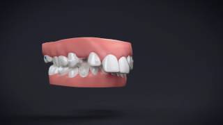 Invisalign Treatment with Mandibular Advancement 11 [upl. by Robet]