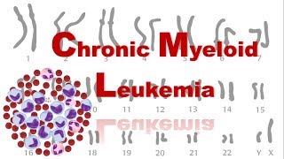 Targeted Therapy for Acute Myeloid Leukemia [upl. by Noel]