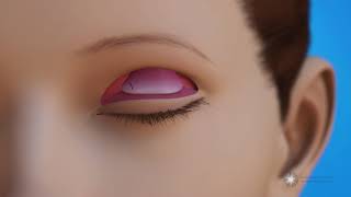 Levator Resection for Ptosis Repair Surgery Eyelid Lift [upl. by Hudson]