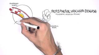 Cardiovascular Disease Overview [upl. by Kerrison101]