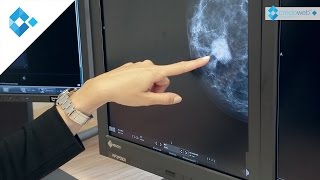 Brustdiagnostik  Knoten frühzeitig erkennen [upl. by Norrab]