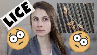 How to Remove Head Lice  WebMD [upl. by Secnirp]