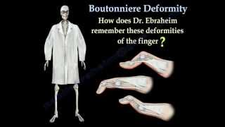 Mallet Finger Treatment  Everything You Need To Know  Dr Nabil Ebraheim [upl. by Enomes]