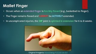 Mallet Finger Hindi [upl. by Clere]