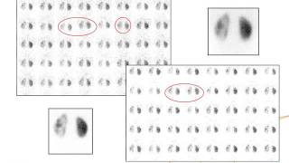 IAEAESNM Webinar  Cortical static renal scintigraphy and radionuclide cystographies [upl. by Ariaet110]