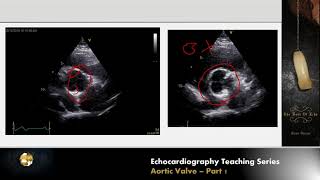 DAY 1 Mechanical Valve Options In Aortic Stenosis [upl. by Stock]