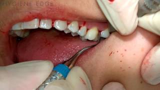 Gracey Instrumentation During Periodontal Therapy [upl. by Parshall]