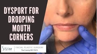 Dysport Injections to DAO Muscle for Drooping Mouth Corners [upl. by Andromache940]