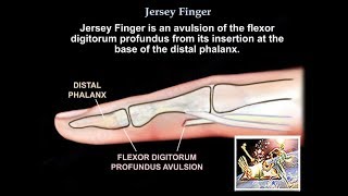 Splinting Mallet Kinesiology Taping Technique [upl. by Finella]