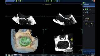 Mitral Valve Analysis TomTec [upl. by Andromache]