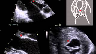 Lecture 9  Aortic Valve Part 1 [upl. by Siramay469]