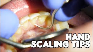 Dental Cleaning  Hand Scaling Tips [upl. by Kara679]